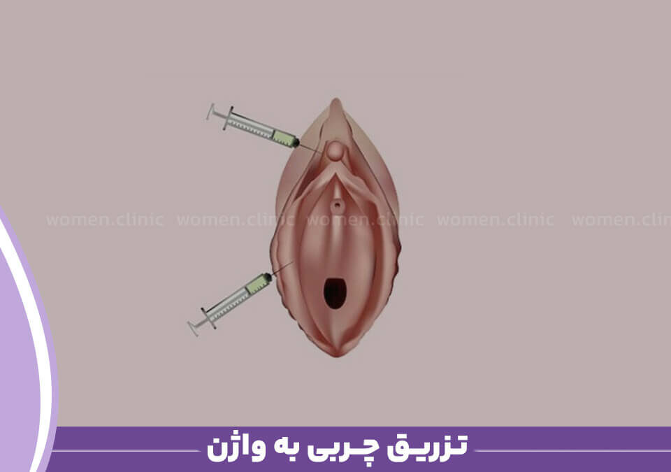 تزریق چربی به واژن